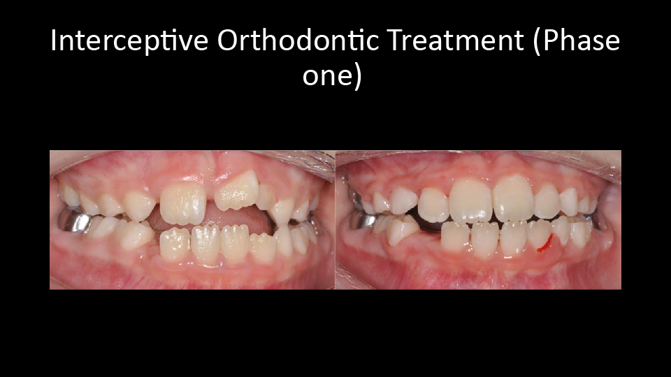 Phase One Orthodontics Treatment