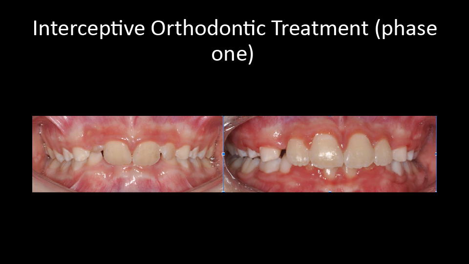 Interceptive Orthodontic treatment (phase one)