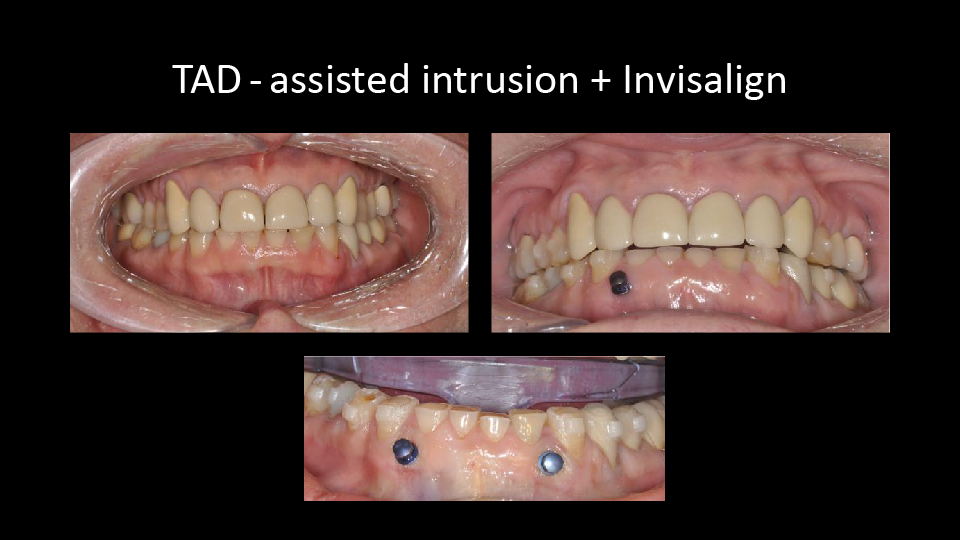 TAD - Assisted intrusion + Invisalign