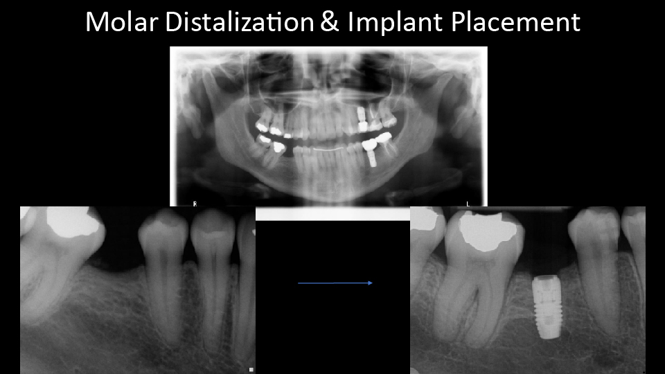Molar Distalization and Implant Placement