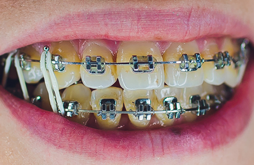 Loose Brackets, Wires Or Bands