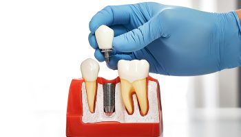 Does Getting a Dental Implant Hurt—or Is It Quick and Painless?
