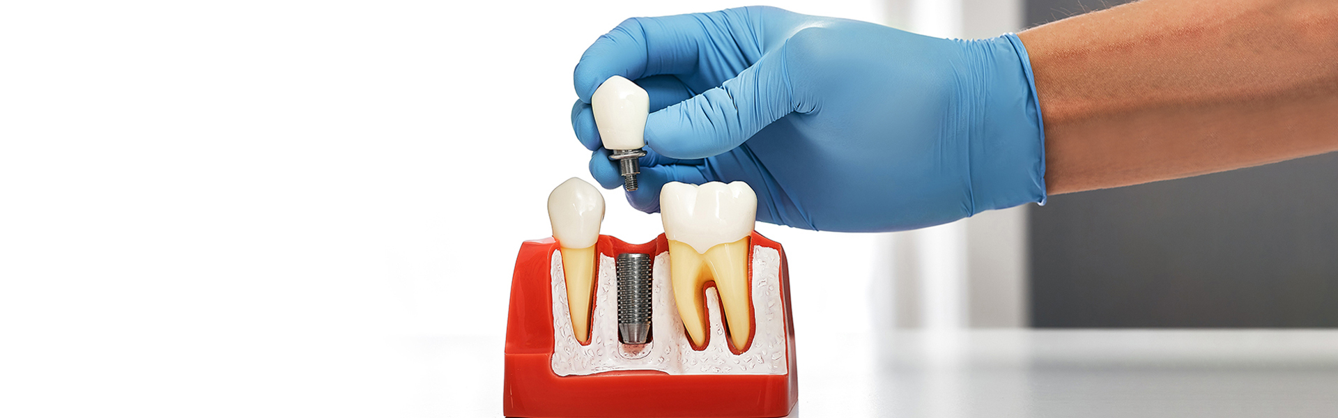 Does Getting a Dental Implant Hurt—or Is It Quick and Painless?