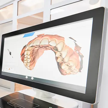 Implant Placement
